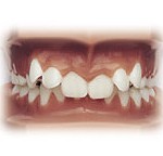 Orthodontic braces invisalign in Elwood